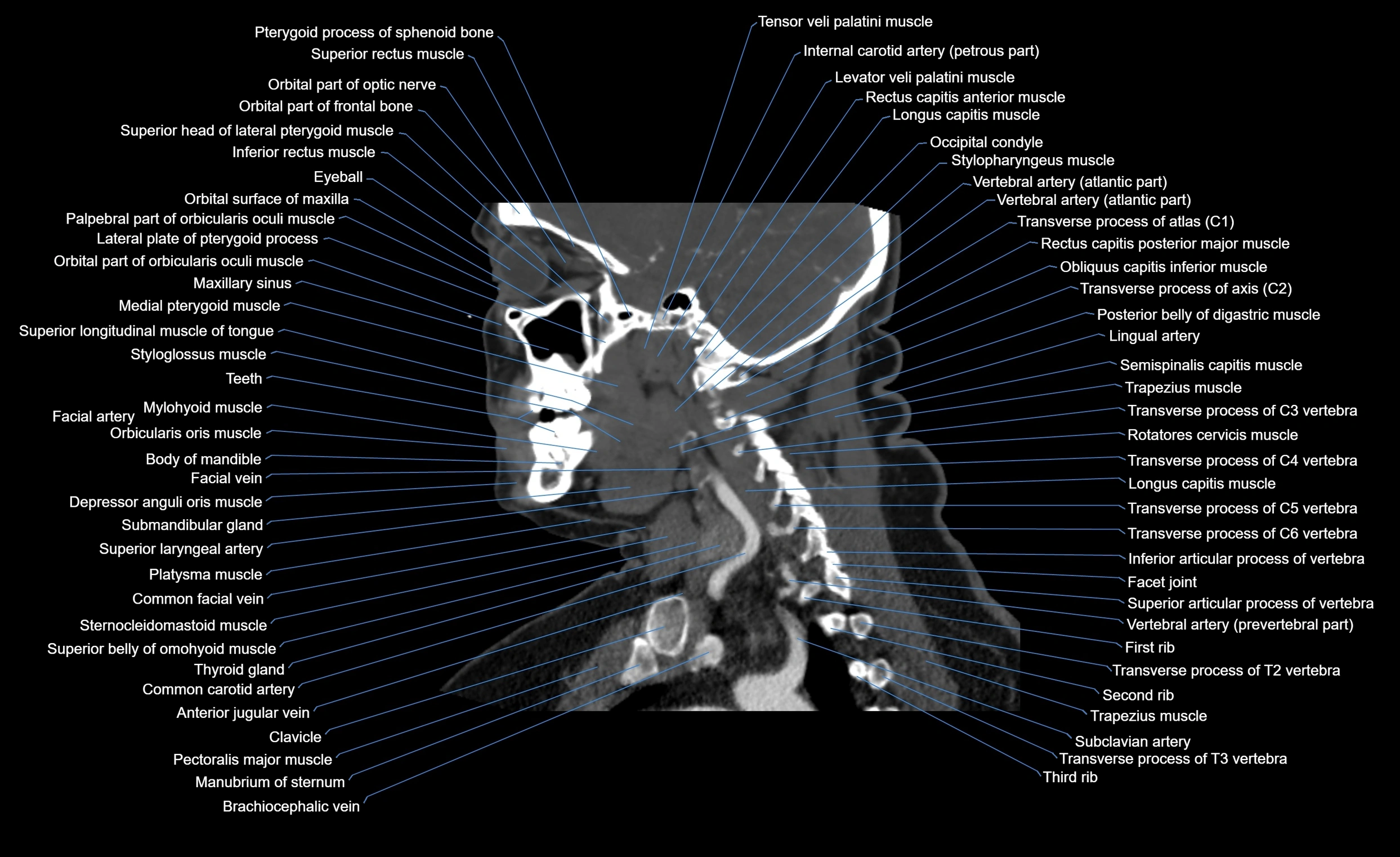 Neck CT sagittal cross sectional anatomy 3D  radiology  image-img-00001-00009.webp